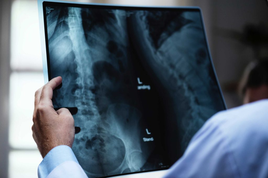 Scoliosis Xray