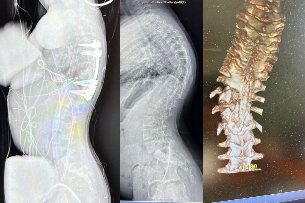 Congenital Kyphoscoliosis A